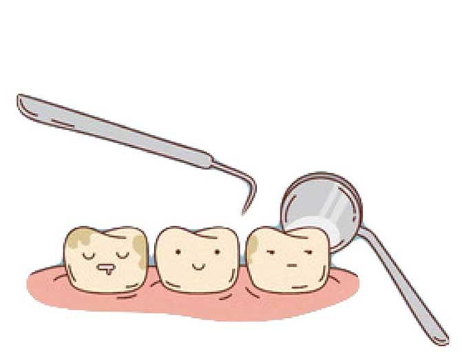 Selladores de fosas y fisuras